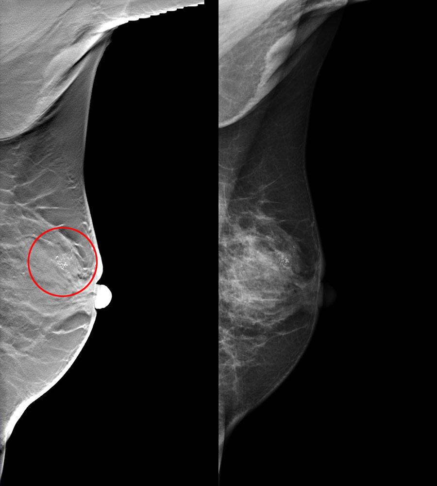 tomosynthesis 3d mammography tomosynthesis 3d mammography