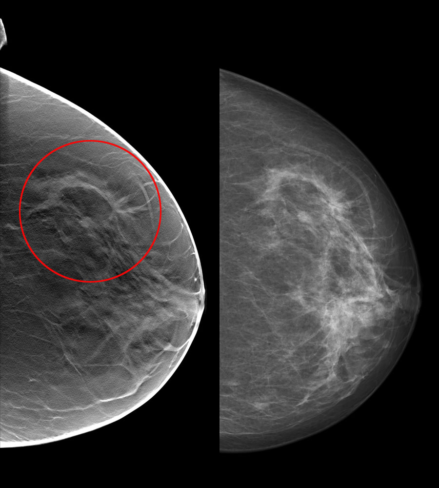 siemens tomosynthesis mammography siemens tomosynthesis mammography